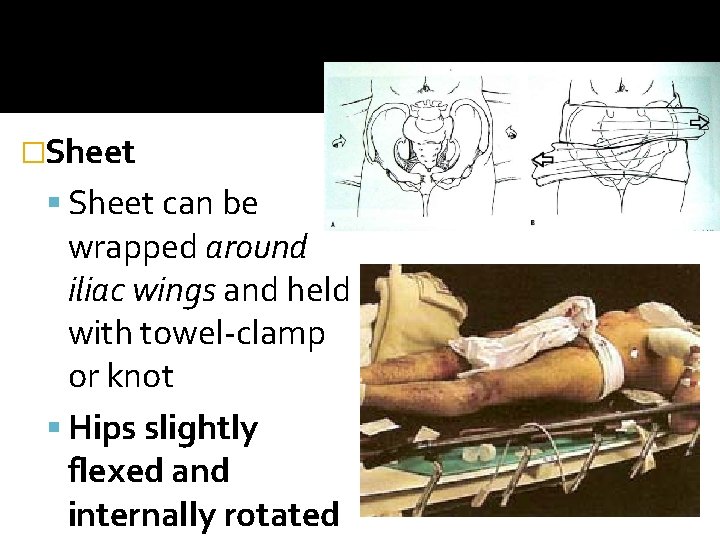 �Sheet can be wrapped around iliac wings and held with towel-clamp or knot Hips