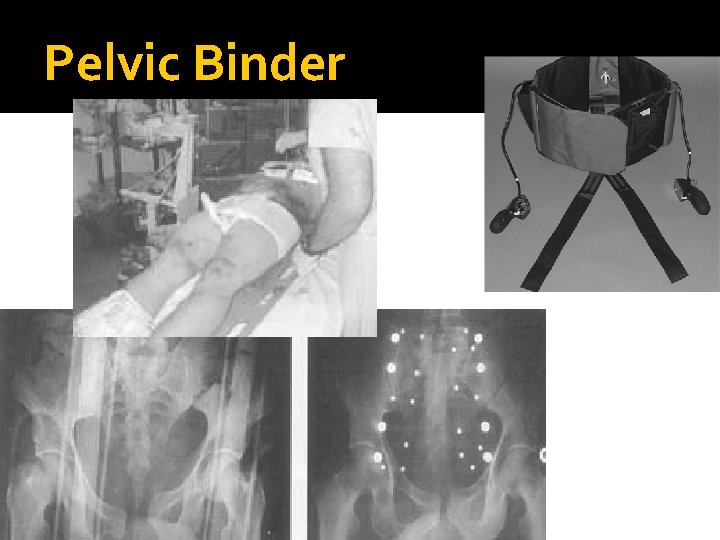 Pelvic Binder 