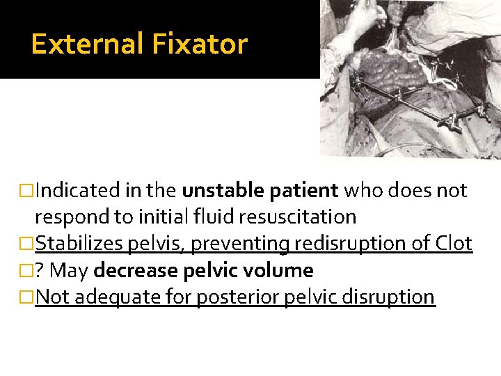 External Fixator �Indicated in the unstable patient who does not respond to initial fluid