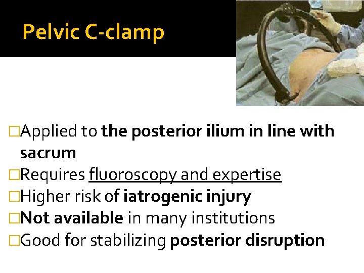 Pelvic C-clamp �Applied to the posterior ilium in line with sacrum �Requires fluoroscopy and