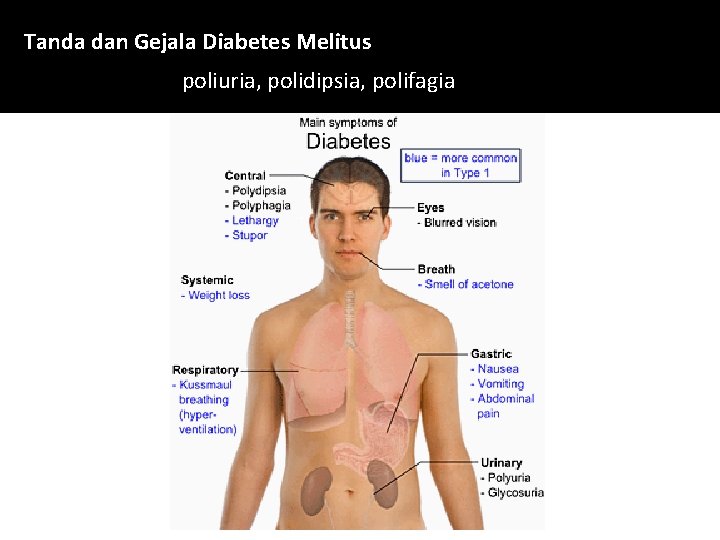 Tanda dan Gejala Diabetes Melitus poliuria, polidipsia, polifagia 