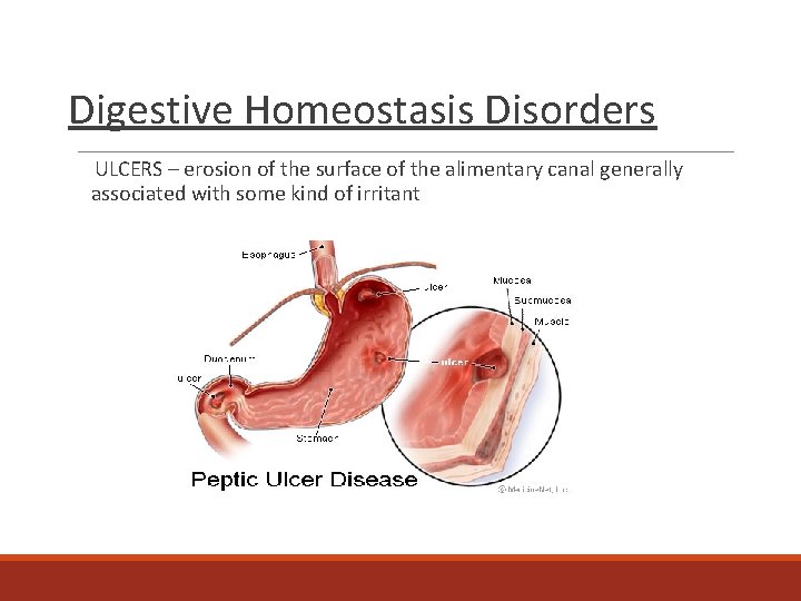 Digestive Homeostasis Disorders ULCERS – erosion of the surface of the alimentary canal generally