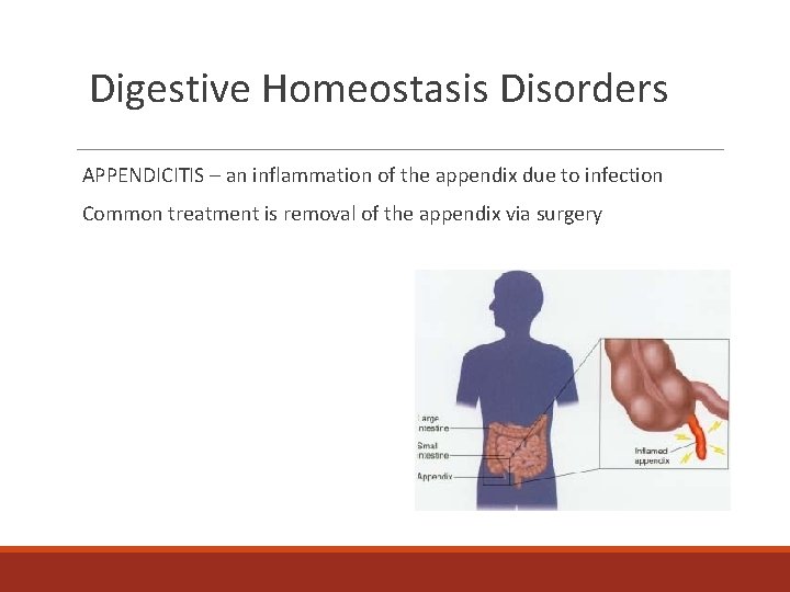 Digestive Homeostasis Disorders APPENDICITIS – an inflammation of the appendix due to infection Common