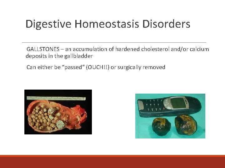 Digestive Homeostasis Disorders GALLSTONES – an accumulation of hardened cholesterol and/or calcium deposits in