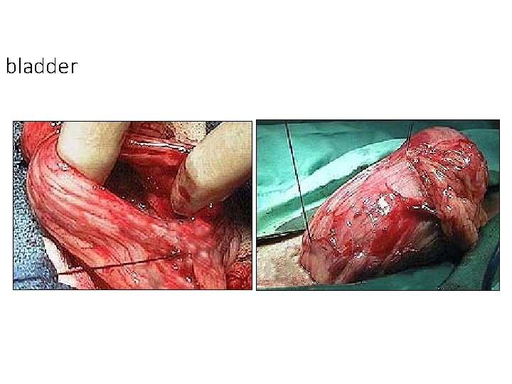 bladder bladder