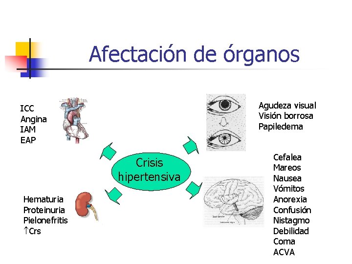 Afectación de órganos Agudeza visual Visión borrosa Papiledema ICC Angina IAM EAP Crisis hipertensiva