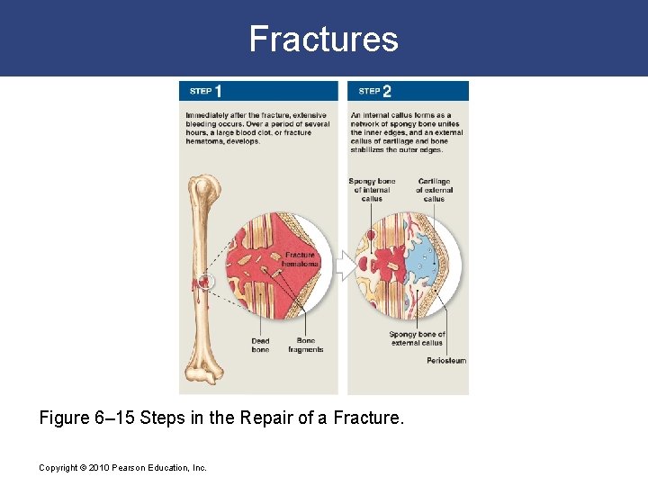 Fractures Figure 6– 15 Steps in the Repair of a Fracture. Copyright © 2010