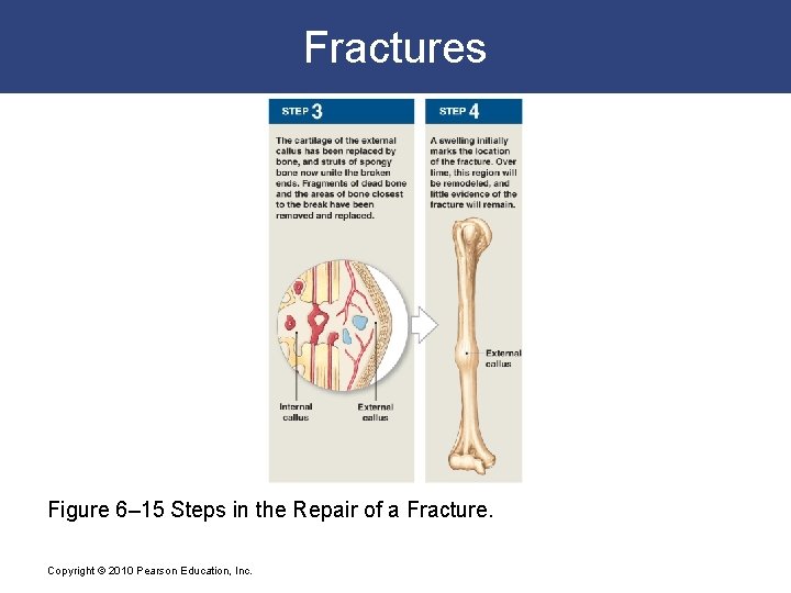 Fractures Figure 6– 15 Steps in the Repair of a Fracture. Copyright © 2010