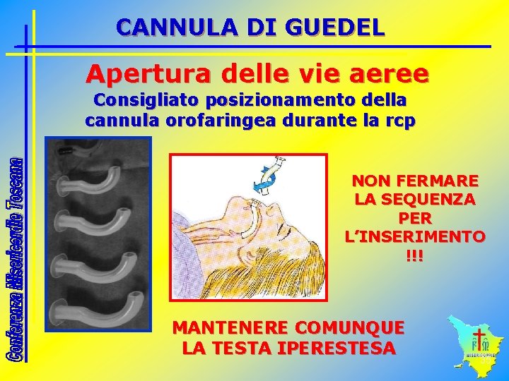 CANNULA DI GUEDEL Apertura delle vie aeree Consigliato posizionamento della cannula orofaringea durante la