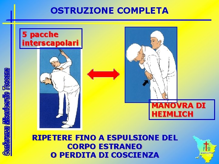 OSTRUZIONE COMPLETA 5 pacche interscapolari MANOVRA DI HEIMLICH RIPETERE FINO A ESPULSIONE DEL CORPO