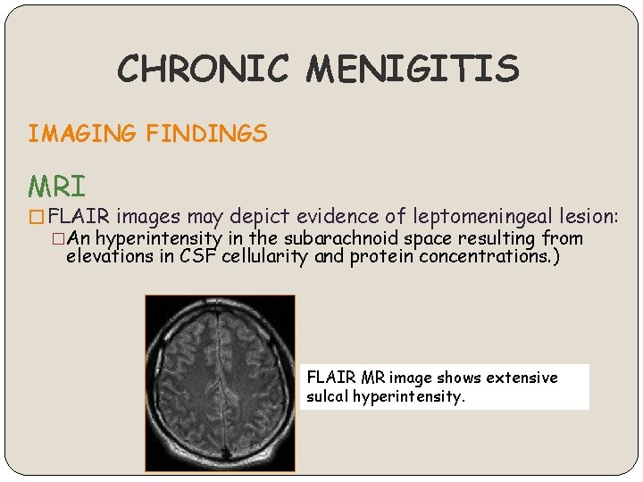 CHRONIC MENIGITIS IMAGING FINDINGS MRI � FLAIR images may depict evidence of leptomeningeal lesion:
