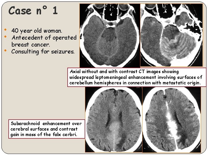 Case n° 1 • • • 40 year old woman. Antecedent of operated breast