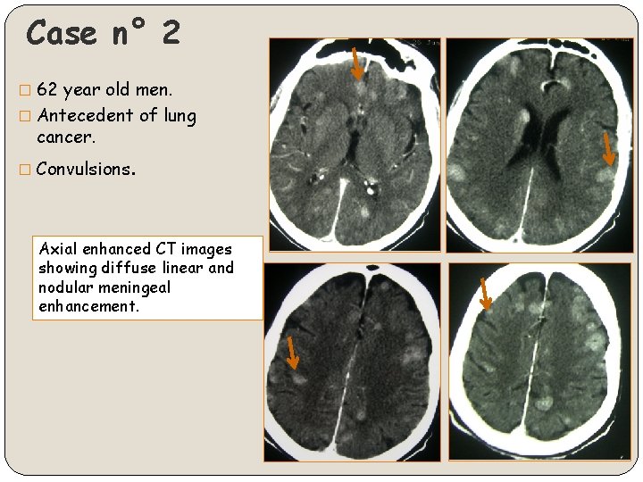 Case n° 2 � 62 year old men. � Antecedent of lung cancer. �