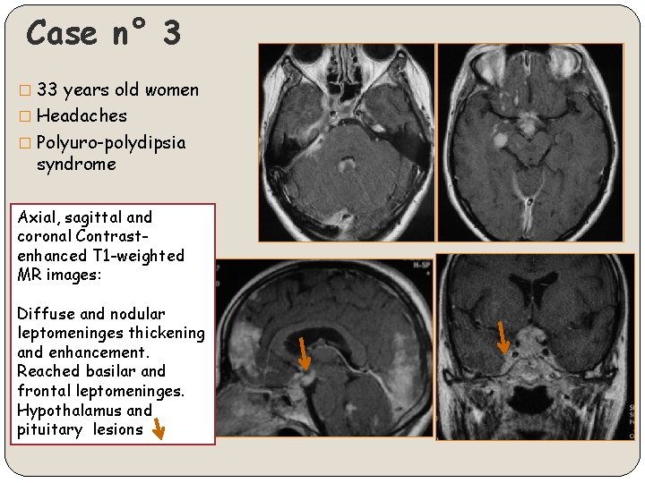 Case n° 3 � 33 years old women � Headaches � Polyuro-polydipsia syndrome Axial,