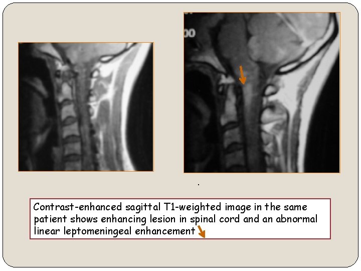 . Contrast-enhanced sagittal T 1 -weighted image in the same patient shows enhancing lesion