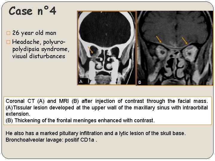 Case n° 4 � 26 year old man � Headache, polyuro- polydipsia syndrome, visual