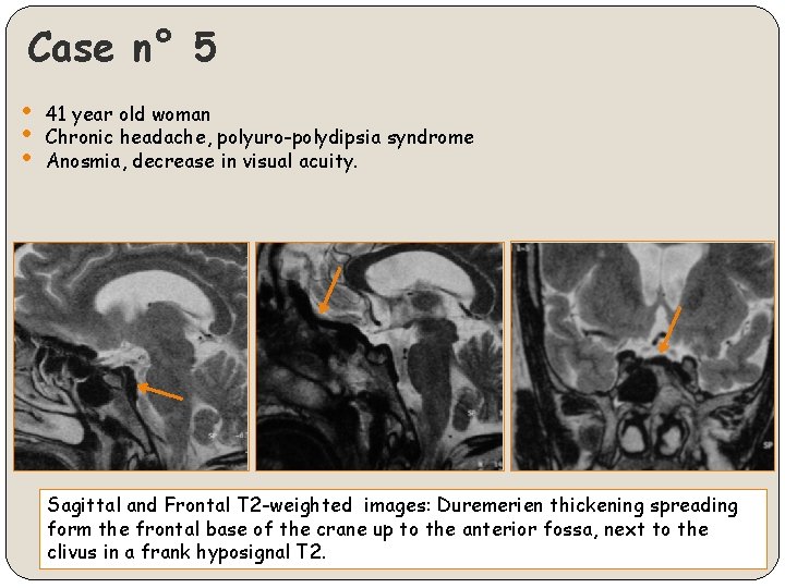 Case n° 5 • • • 41 year old woman Chronic headache, polyuro-polydipsia syndrome