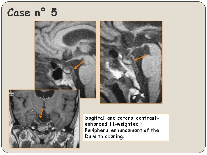 Case n° 5 Sagittal and coronal contrastenhanced T 1 -weighted : Peripheral enhancement of