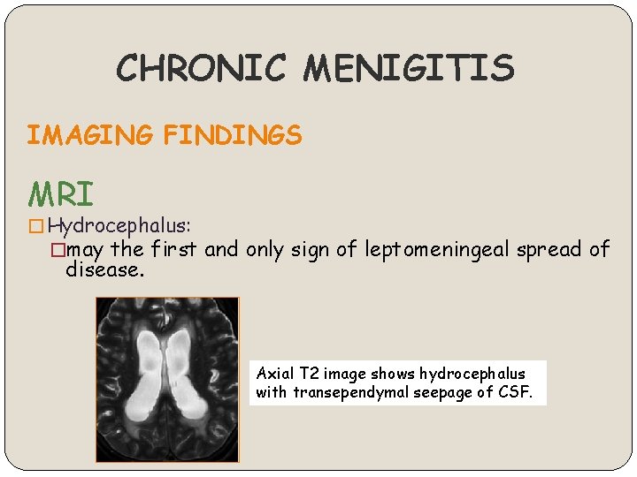 CHRONIC MENIGITIS IMAGING FINDINGS MRI � Hydrocephalus: �may the first and only sign of