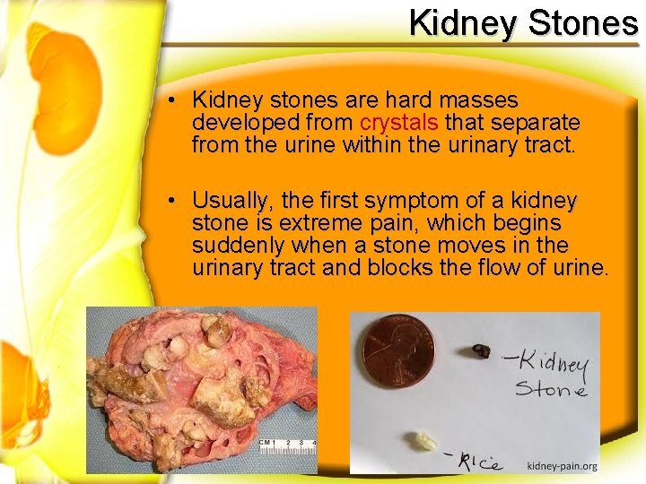 Kidney Stones • Kidney stones are hard masses developed from crystals that separate from