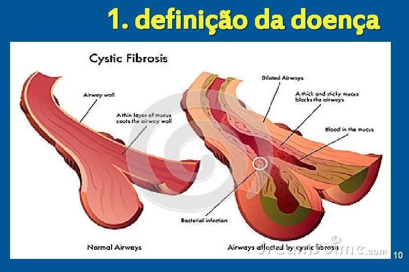 1. definição da doença 10 