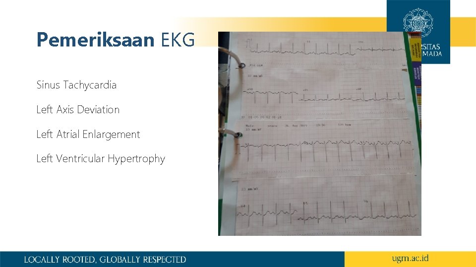 Pemeriksaan EKG Sinus Tachycardia Left Axis Deviation Left Atrial Enlargement Left Ventricular Hypertrophy 