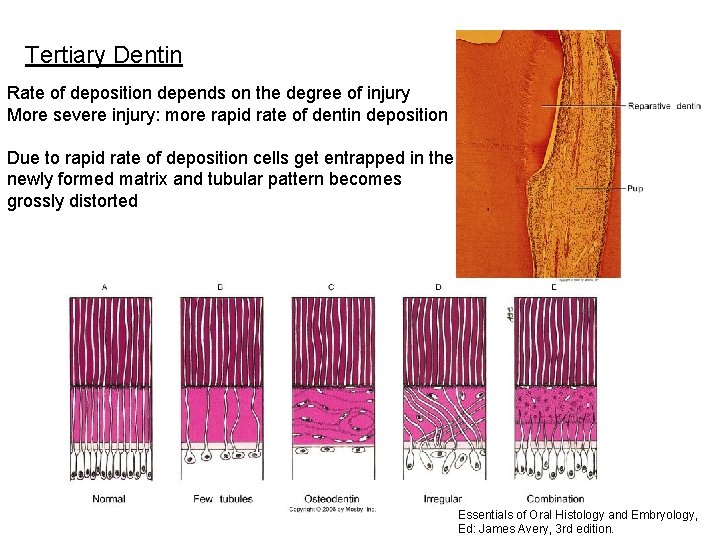 Tertiary Dentin Rate of deposition depends on the degree of injury More severe injury: