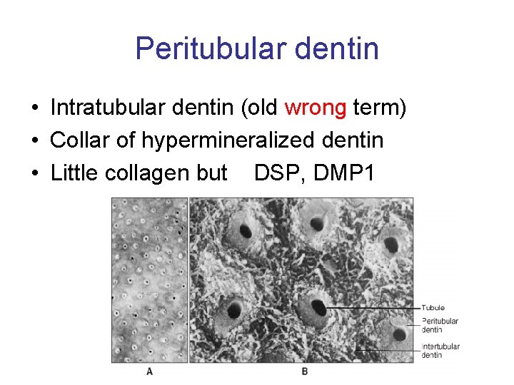 Peritubular dentin • Intratubular dentin (old wrong term) • Collar of hypermineralized dentin •