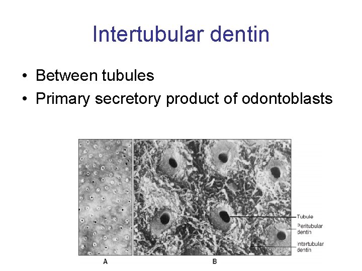 Intertubular dentin • Between tubules • Primary secretory product of odontoblasts 