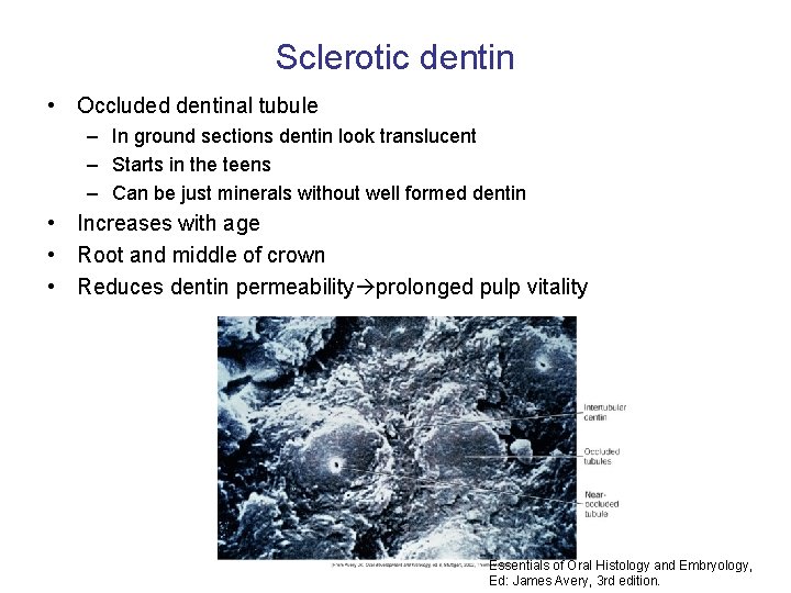 Sclerotic dentin • Occluded dentinal tubule – In ground sections dentin look translucent –