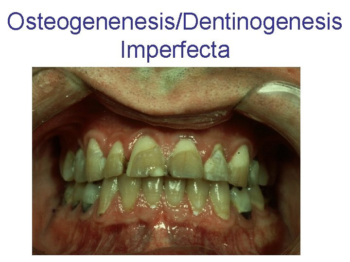 Osteogenenesis/Dentinogenesis Imperfecta 