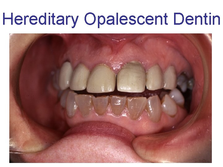 Hereditary Opalescent Dentin 
