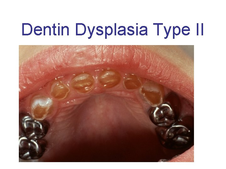 Dentin Dysplasia Type II 