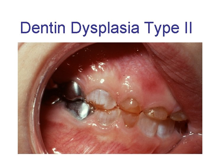 Dentin Dysplasia Type II 