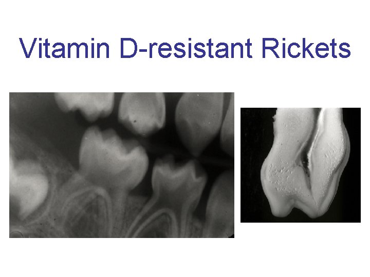 Vitamin D-resistant Rickets 