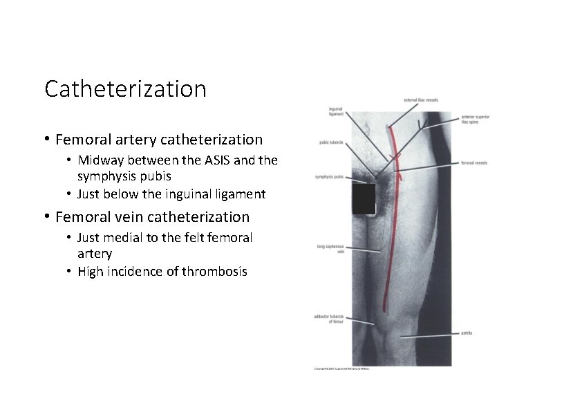 Catheterization • Femoral artery catheterization • Midway between the ASIS and the symphysis pubis