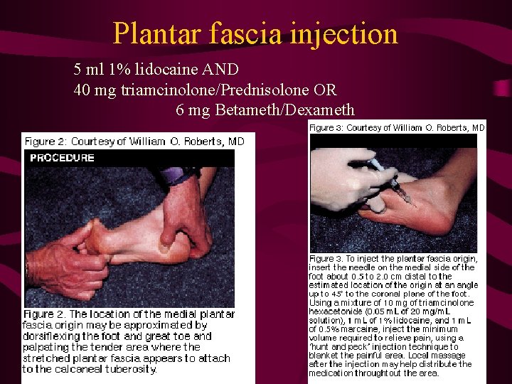 Plantar fascia injection 5 ml 1% lidocaine AND 40 mg triamcinolone/Prednisolone OR 6 mg