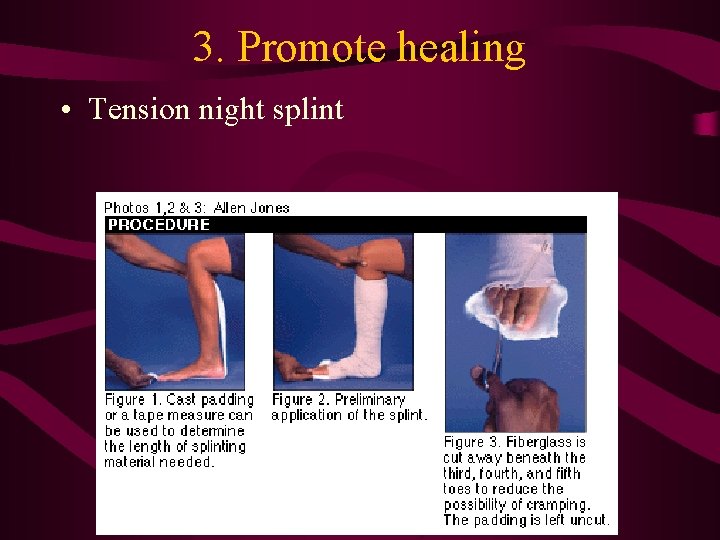3. Promote healing • Tension night splint 