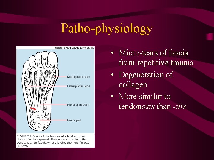 Patho-physiology • Micro-tears of fascia from repetitive trauma • Degeneration of collagen • More
