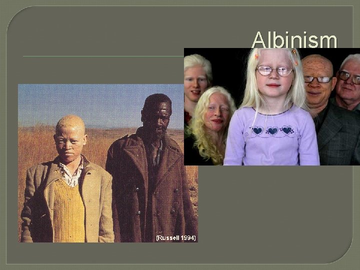 Albinism 