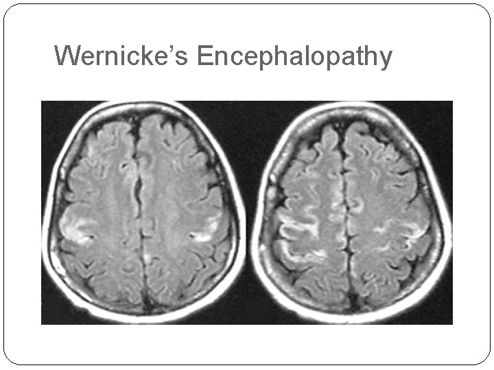 Wernicke’s Encephalopathy 