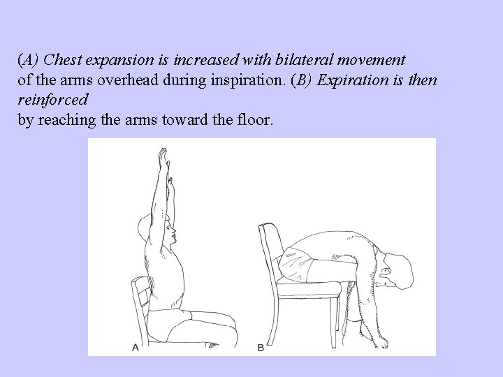 (A) Chest expansion is increased with bilateral movement of the arms overhead during inspiration.