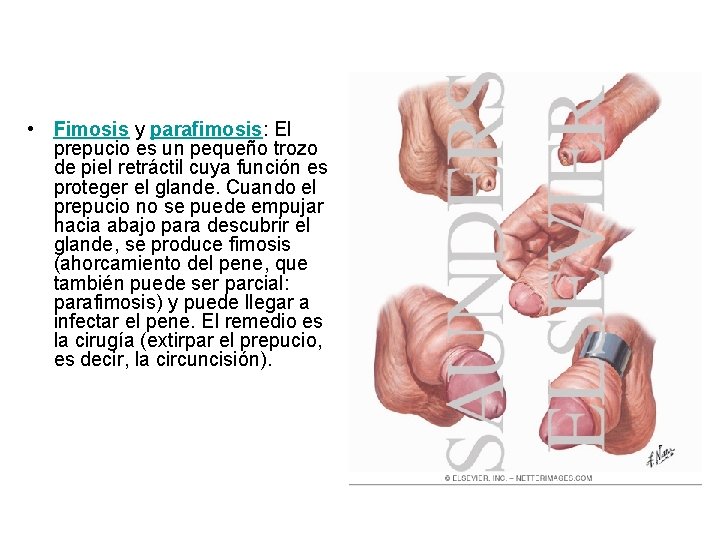  • Fimosis y parafimosis: El prepucio es un pequeño trozo de piel retráctil