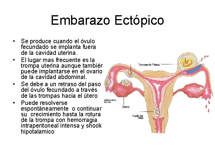 Embarazo Ectópico • Se produce cuando el óvulo fecundado se implanta fuera de la