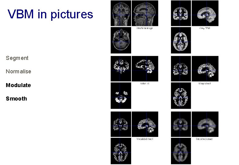 VBM in pictures Segment Normalise Modulate Smooth 