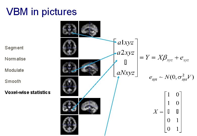 VBM in pictures Segment Normalise Modulate Smooth Voxel-wise statistics 