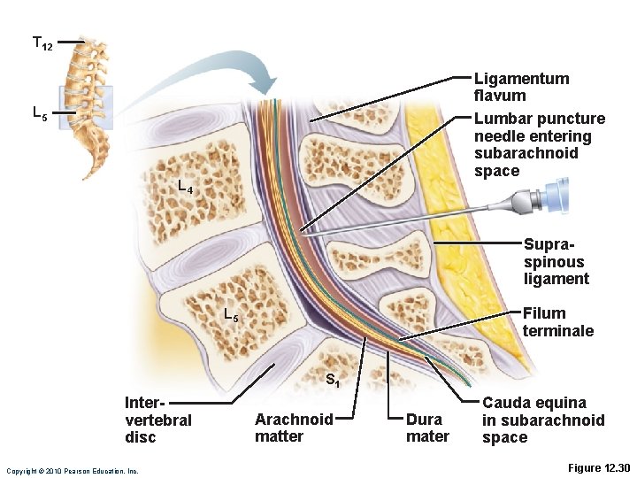 T 12 Ligamentum flavum Lumbar puncture needle entering subarachnoid space L 5 L 4