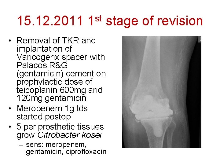 15. 12. 2011 1 st stage of revision • Removal of TKR and implantation