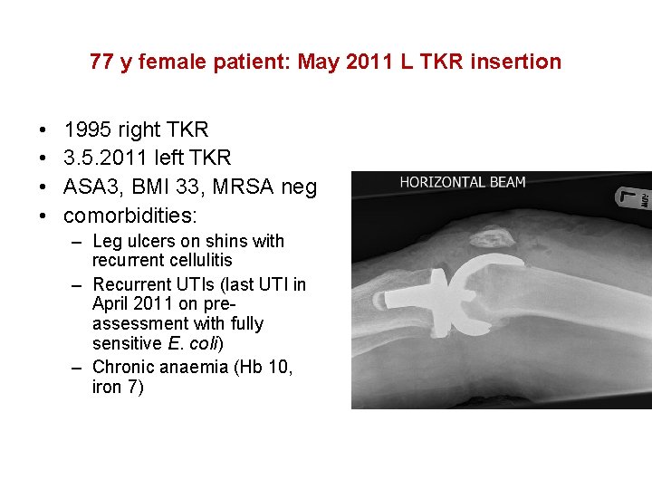 77 y female patient: May 2011 L TKR insertion • • 1995 right TKR