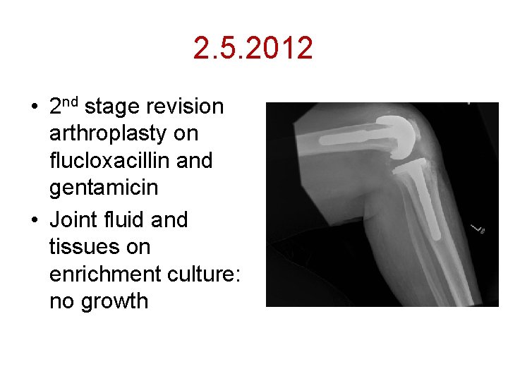 2. 5. 2012 • 2 nd stage revision arthroplasty on flucloxacillin and gentamicin •
